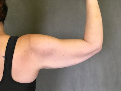 Arm Lift (Brachioplasty) Before & After Gallery - Patient 164216516 - Image 1