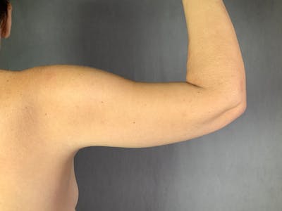 Arm Lift (Brachioplasty) Before & After Gallery - Patient 164216516 - Image 2