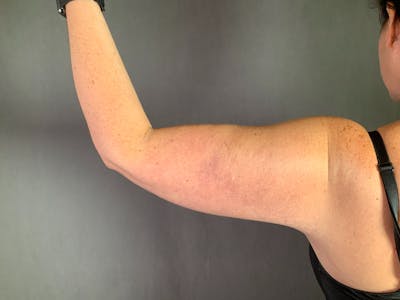 Arm Lift (Brachioplasty) Before & After Gallery - Patient 164216517 - Image 2