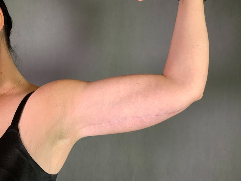 Arm Lift (Brachioplasty) Before & After Gallery - Patient 164216517 - Image 4