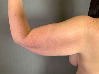 Arm Lift (Brachioplasty) Before & After Gallery - Patient 164216517 - Image 1