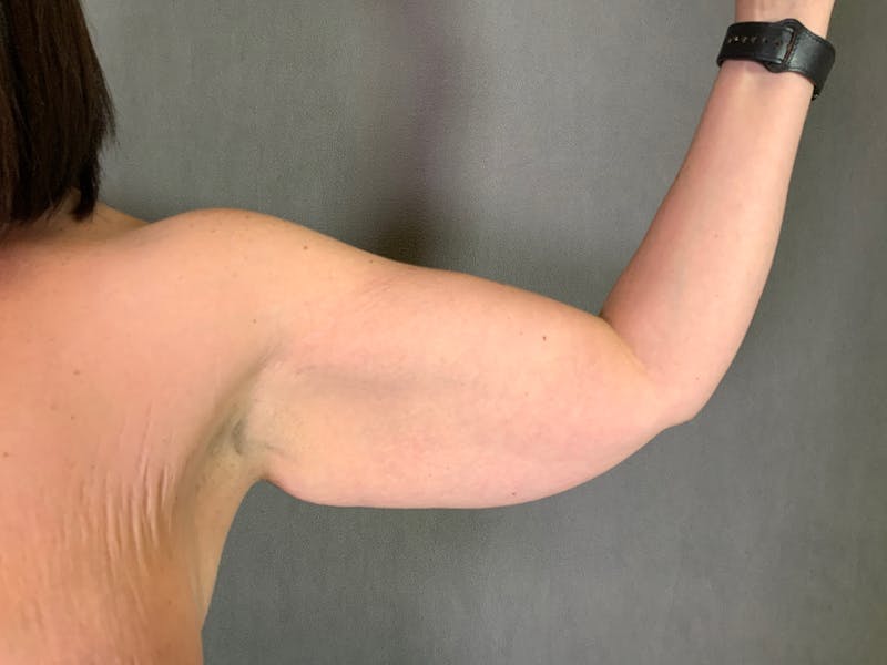 Arm Lift (Brachioplasty) Before & After Gallery - Patient 164216517 - Image 3