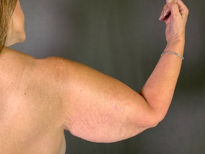 Arm Lift (Brachioplasty) Before & After Gallery - Patient 164217025 - Image 1