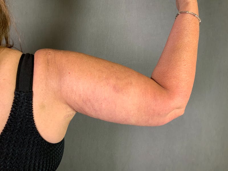 Arm Lift (Brachioplasty) Before & After Gallery - Patient 164217025 - Image 2