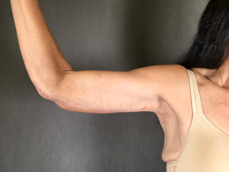 Arm Lift (Brachioplasty) Before & After Gallery - Patient 164217340 - Image 4