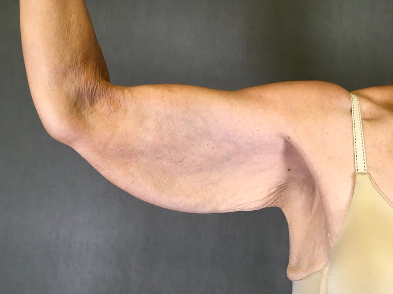 Arm Lift (Brachioplasty) Before & After Gallery - Patient 164217340 - Image 3
