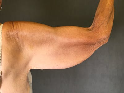 Arm Lift (Brachioplasty) Before & After Gallery - Patient 164217340 - Image 1