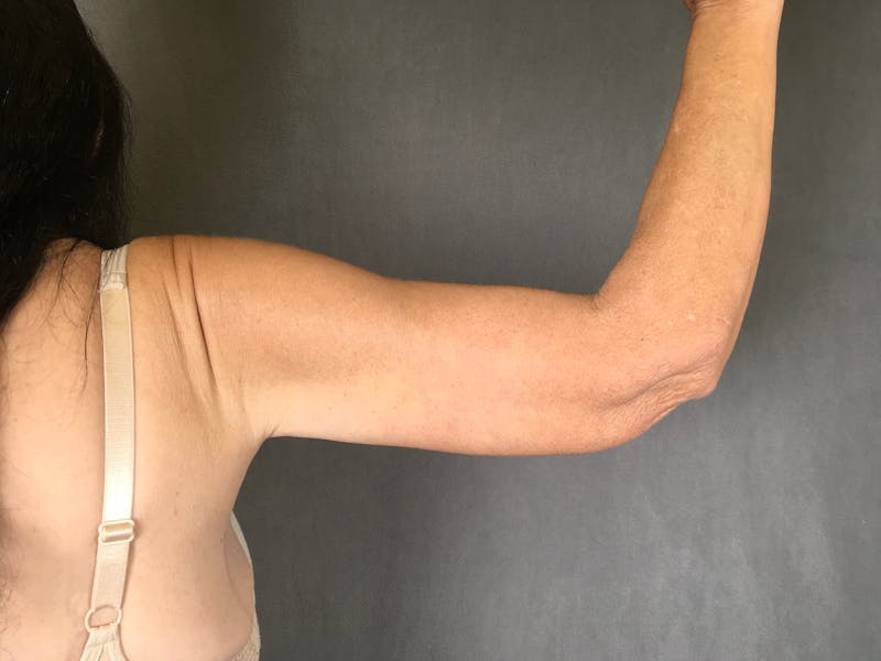 Arm Lift (Brachioplasty) Before & After Gallery - Patient 164217340 - Image 2