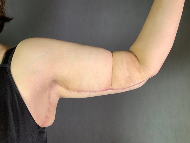 Arm Lift (Brachioplasty) Before & After Gallery - Patient 164217389 - Image 4