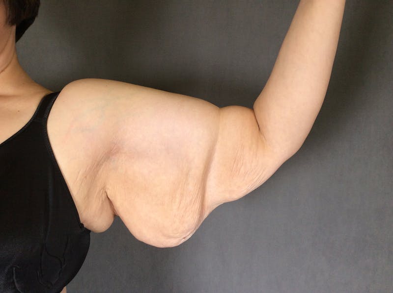 Arm Lift (Brachioplasty) Before & After Gallery - Patient 164217389 - Image 3