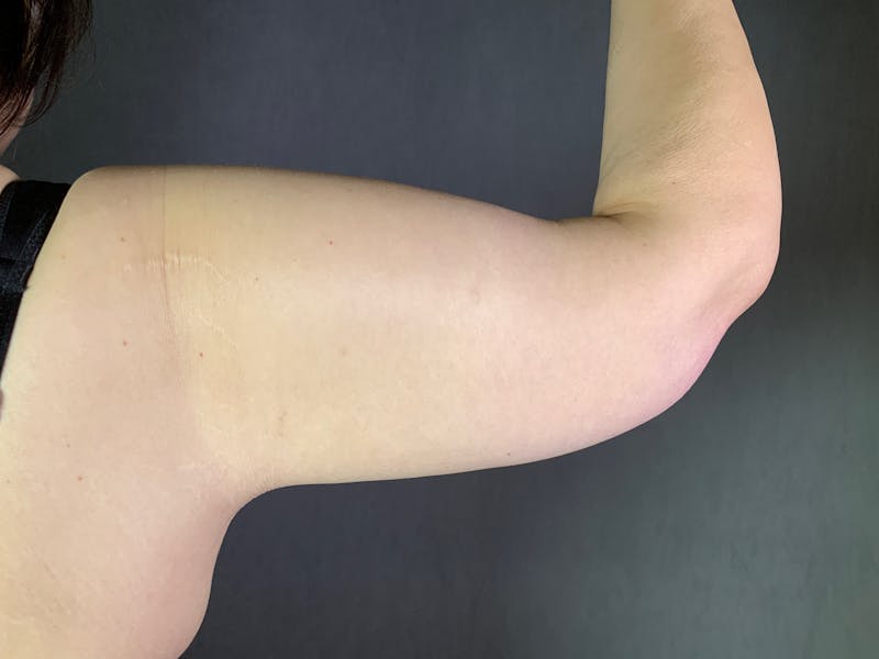 Arm Lift (Brachioplasty) Before & After Gallery - Patient 164217389 - Image 2