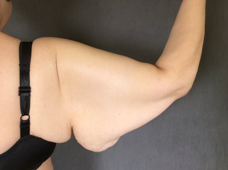 Arm Lift (Brachioplasty) Before & After Gallery - Patient 164217389 - Image 1