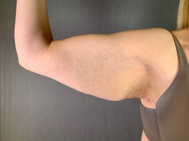 Arm Lift (Brachioplasty) Before & After Gallery - Patient 164217475 - Image 3