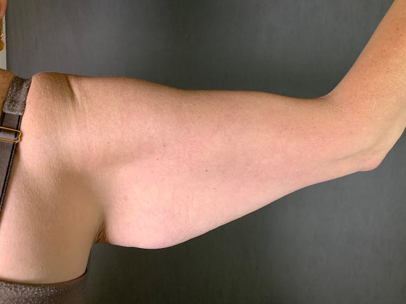 Arm Lift (Brachioplasty) Before & After Gallery - Patient 164217475 - Image 1