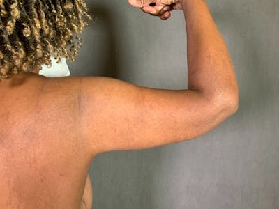 Arm Lift (Brachioplasty) Before & After Gallery - Patient 164217508 - Image 2