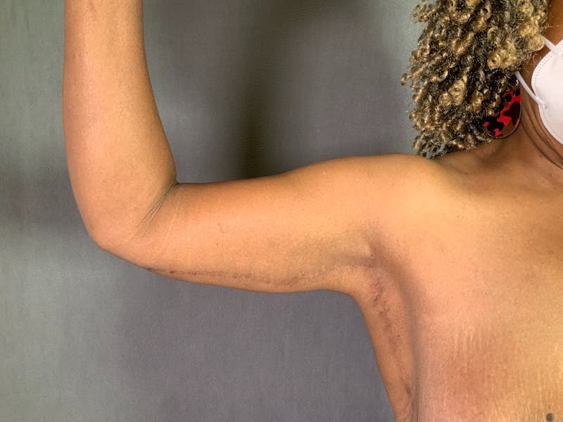 Arm Lift (Brachioplasty) Before & After Gallery - Patient 164217508 - Image 4