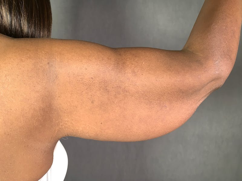 Arm Lift (Brachioplasty) Before & After Gallery - Patient 164217508 - Image 1