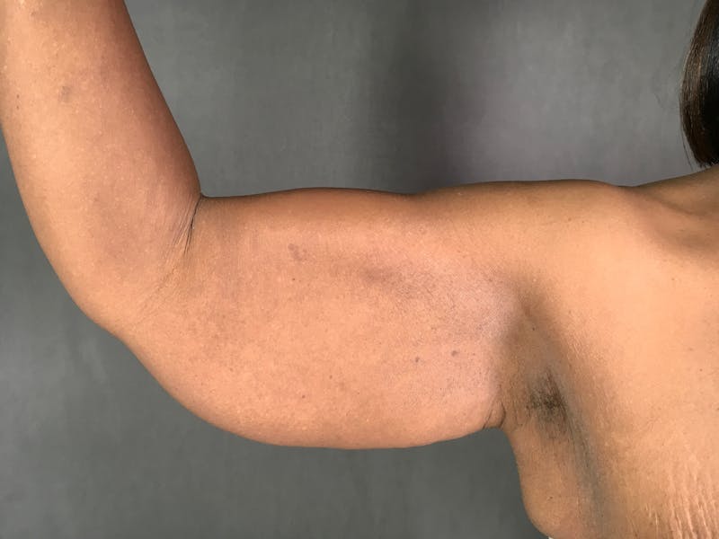 Arm Lift (Brachioplasty) Before & After Gallery - Patient 164217508 - Image 3