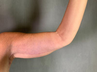 Arm Lift (Brachioplasty) Before & After Gallery - Patient 164217539 - Image 2