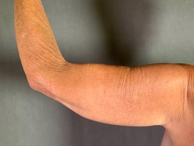 Arm Lift (Brachioplasty) Before & After Gallery - Patient 164217539 - Image 2