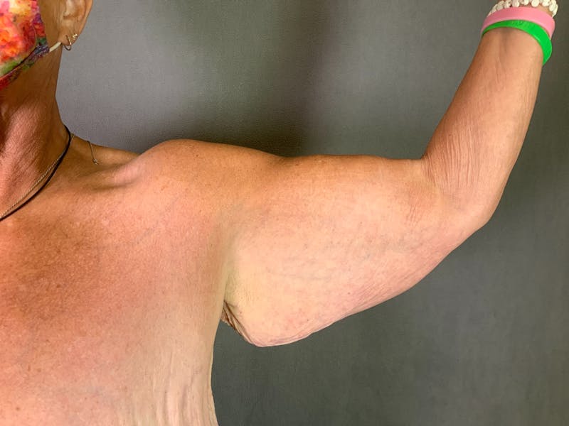 Arm Lift (Brachioplasty) Before & After Gallery - Patient 164217539 - Image 3