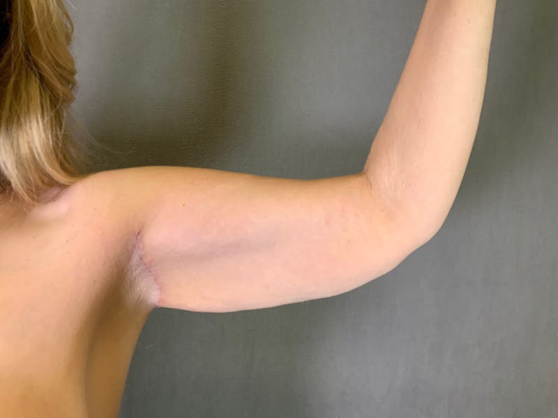Arm Lift (Brachioplasty) Before & After Gallery - Patient 164217587 - Image 2