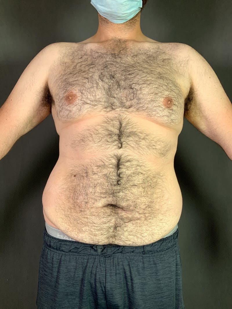 Body Lift Before & After Gallery - Patient 164217680 - Image 1