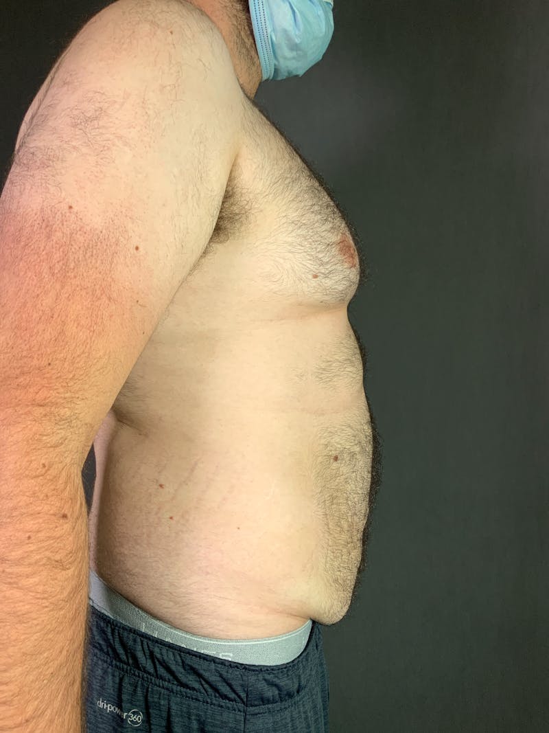 Body Lift Before & After Gallery - Patient 164217680 - Image 3