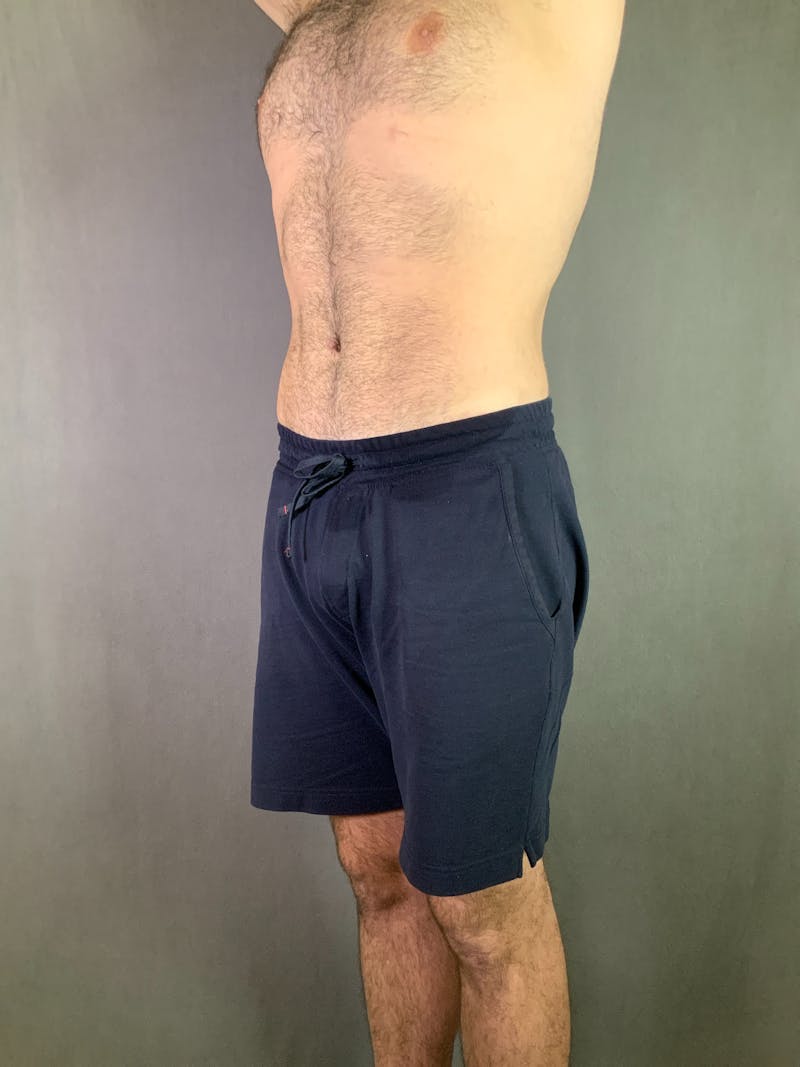 Body Lift Before & After Gallery - Patient 164217680 - Image 6