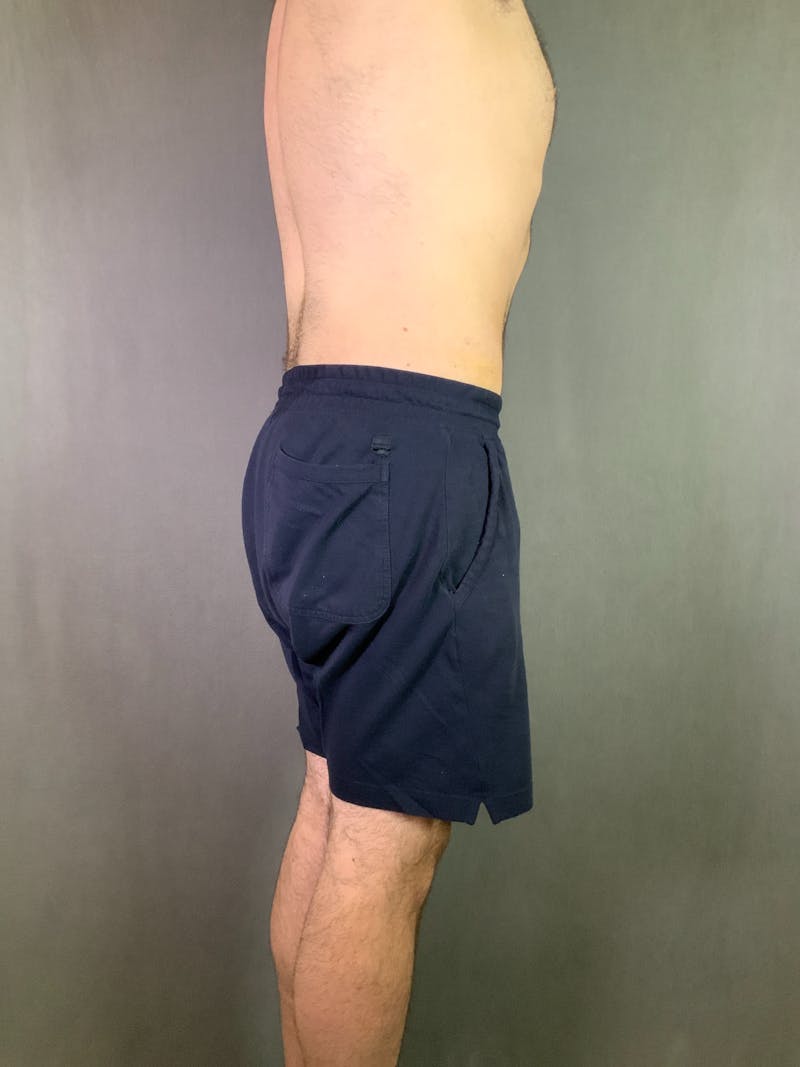 Body Lift Before & After Gallery - Patient 164217680 - Image 4