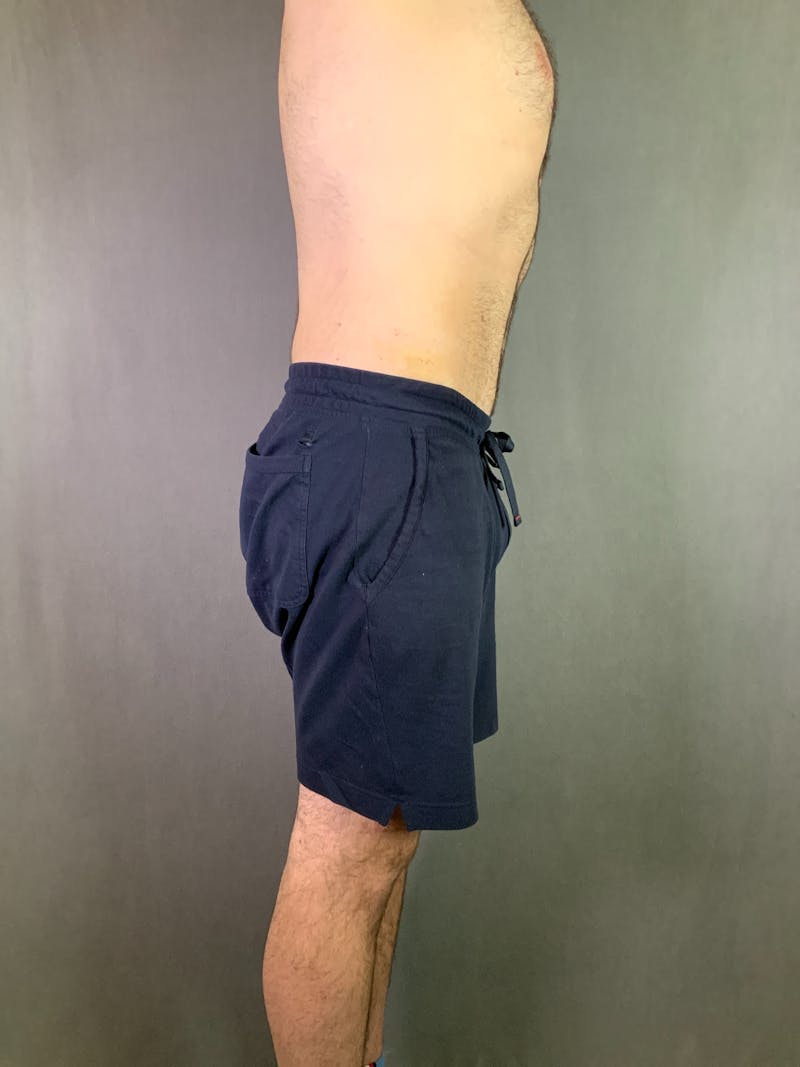 Body Lift Before & After Gallery - Patient 164217680 - Image 8