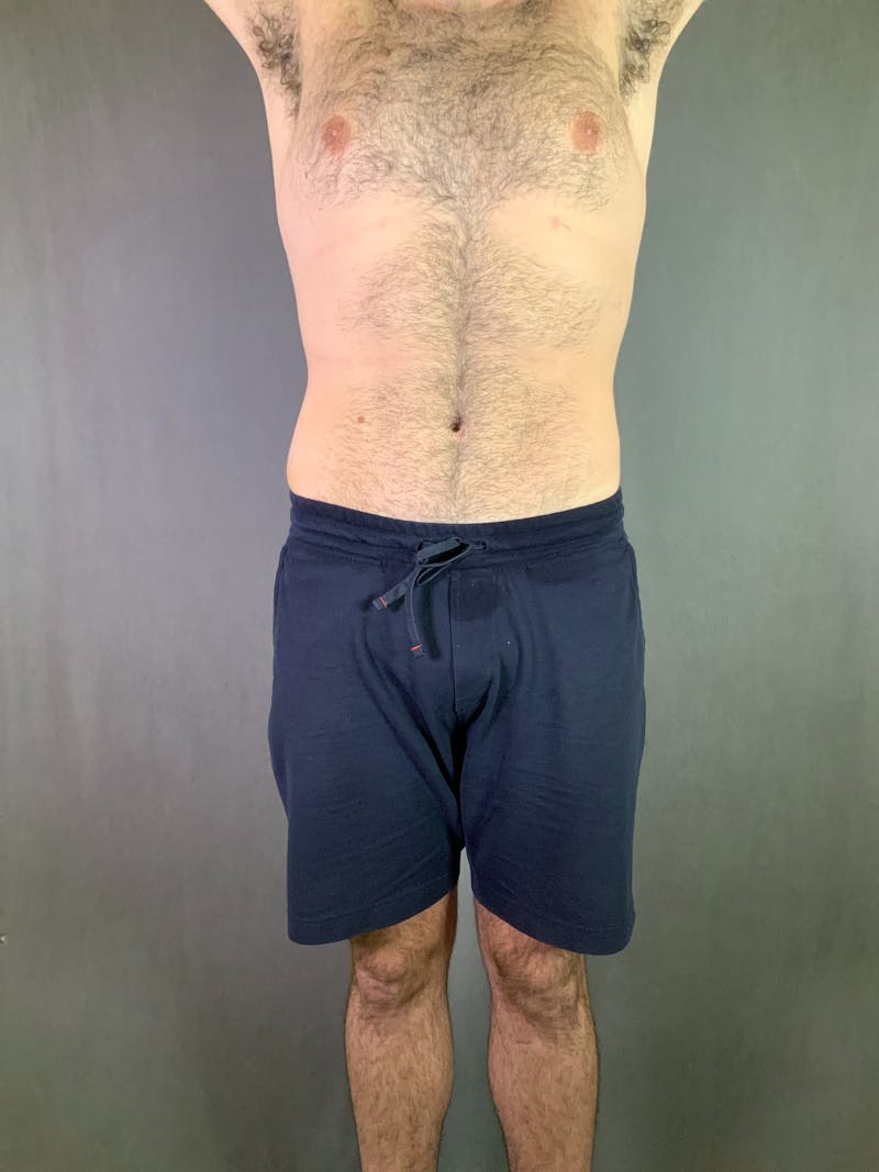 Body Lift Before & After Gallery - Patient 164217680 - Image 2