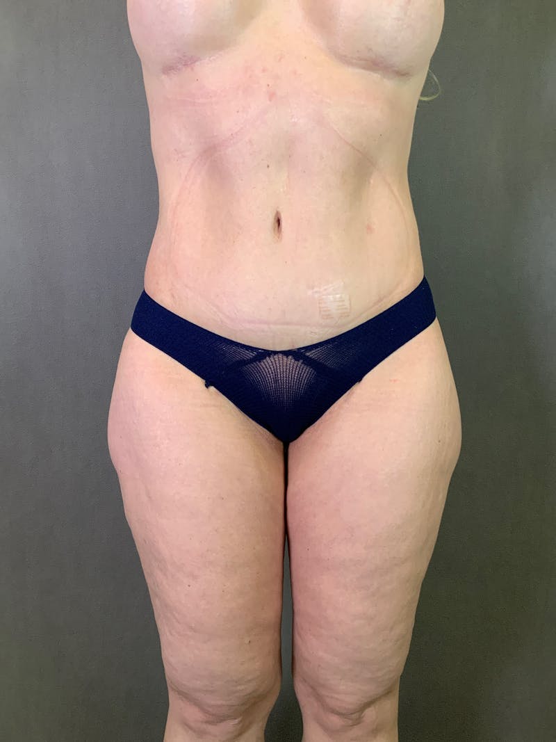 Body Lift Before & After Gallery - Patient 164227569 - Image 2