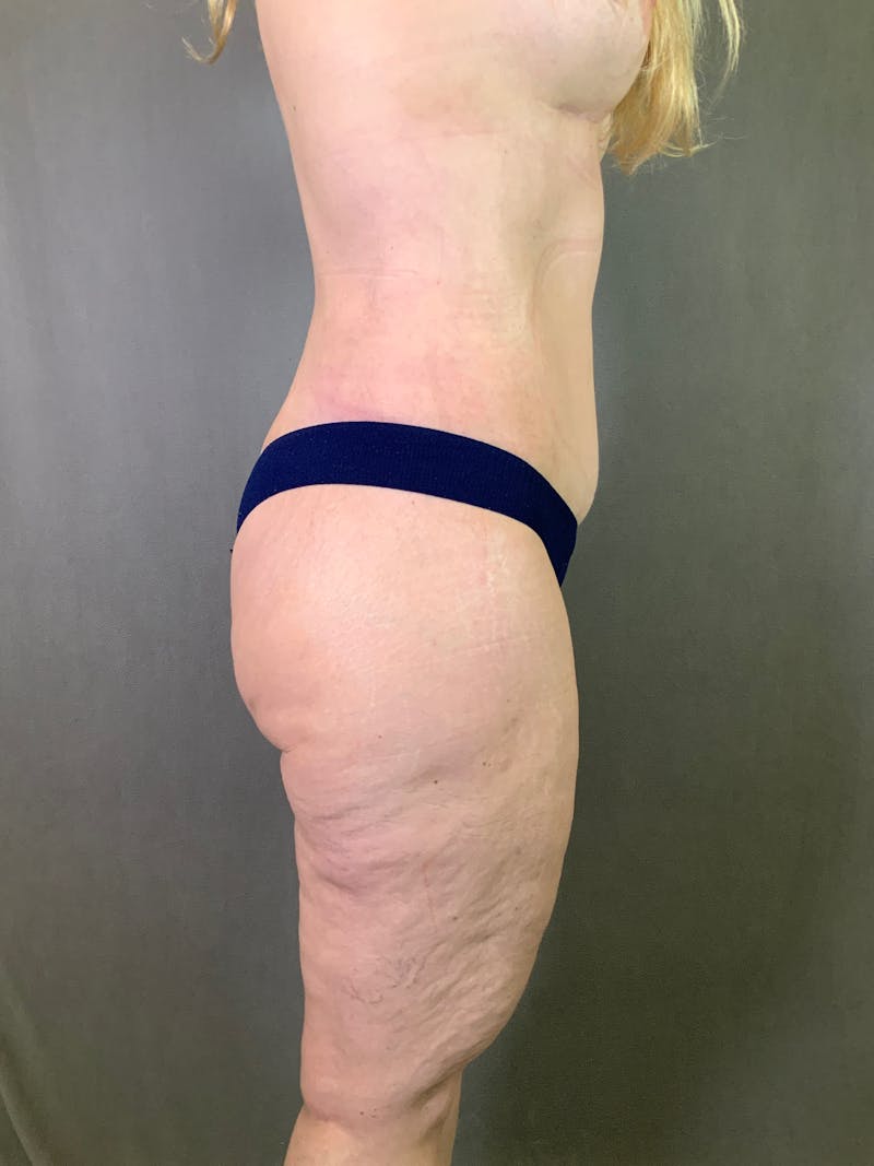 Body Lift Before & After Gallery - Patient 164227569 - Image 4