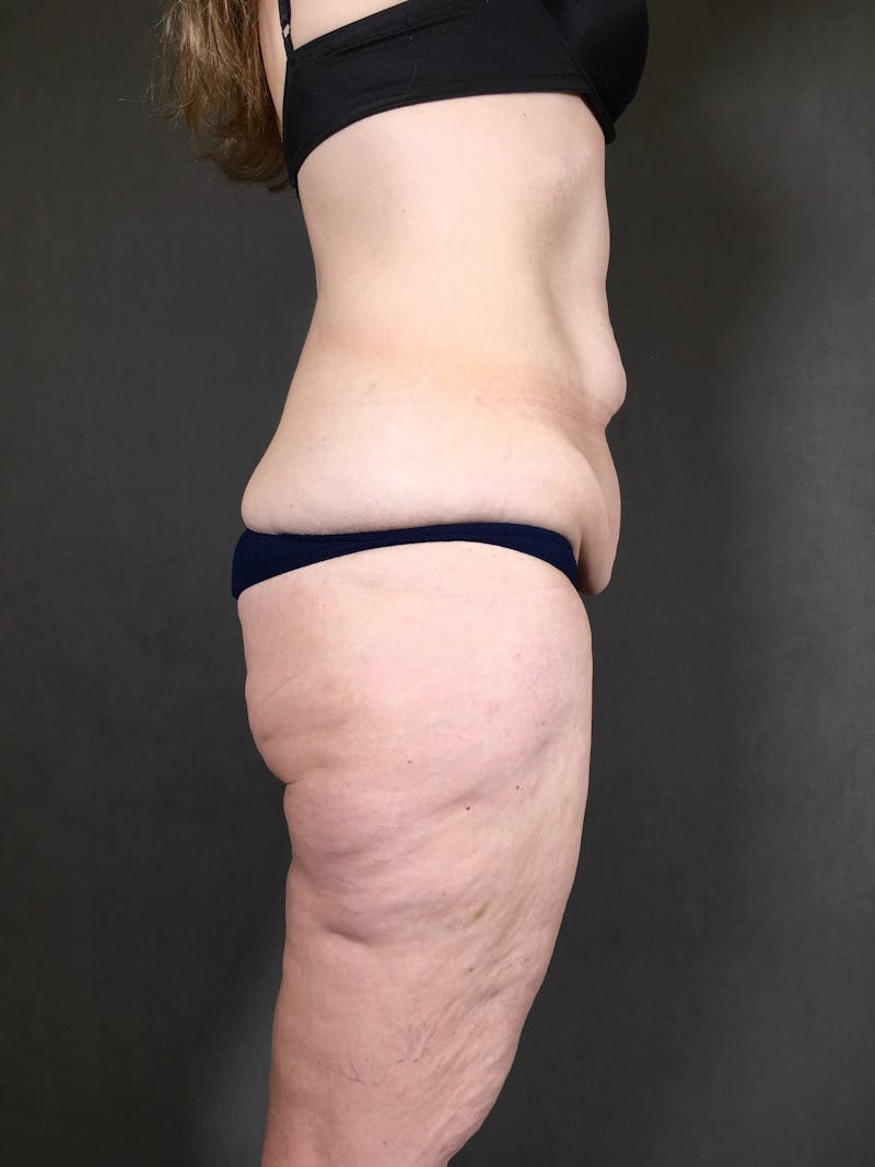 Body Lift Before & After Gallery - Patient 164227569 - Image 3