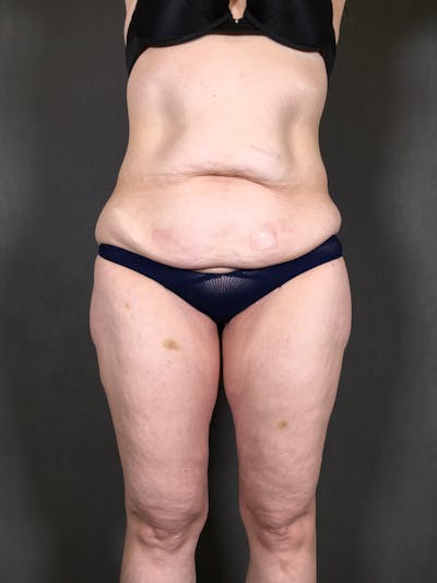 Body Lift Before & After Gallery - Patient 164227569 - Image 1