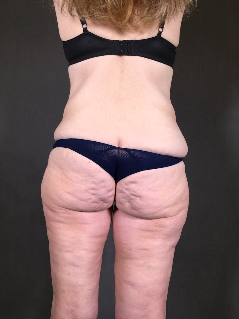 Body Lift Before & After Gallery - Patient 164227569 - Image 7