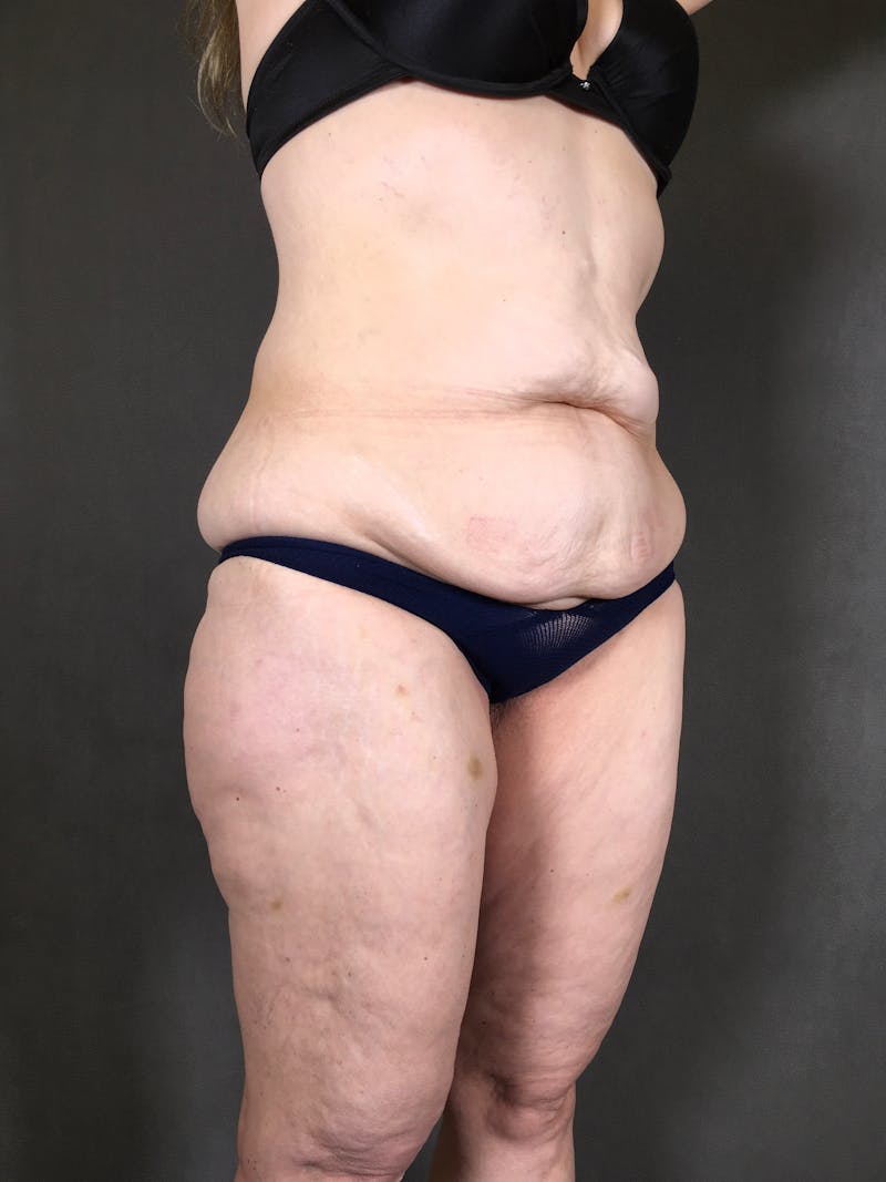 Body Lift Before & After Gallery - Patient 164227569 - Image 5