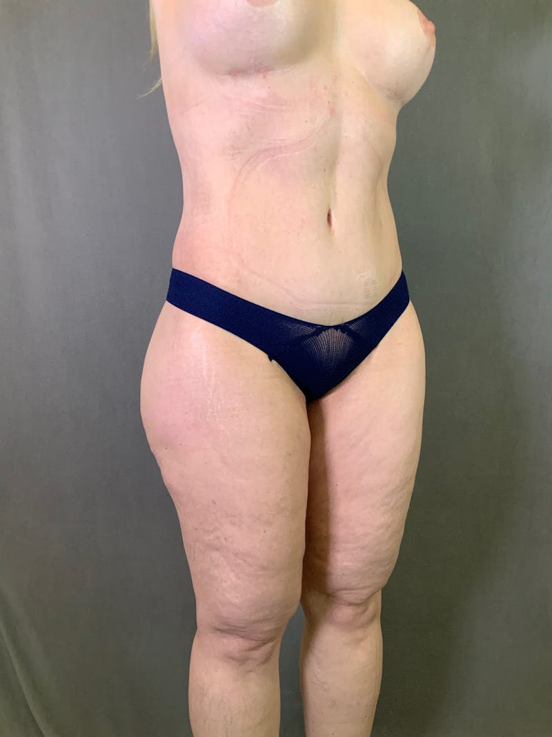 Body Lift Before & After Gallery - Patient 164227569 - Image 6