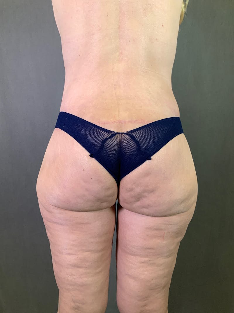 Body Lift Before & After Gallery - Patient 164227569 - Image 8