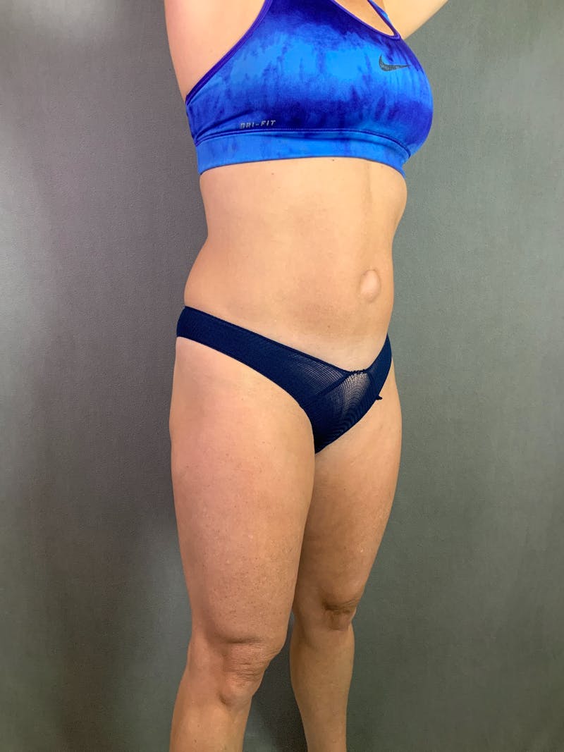 Mini-Tummy Tuck Before & After Gallery - Patient 167403205 - Image 3