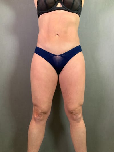 Mini-Tummy Tuck Before & After Gallery - Patient 167403205 - Image 2