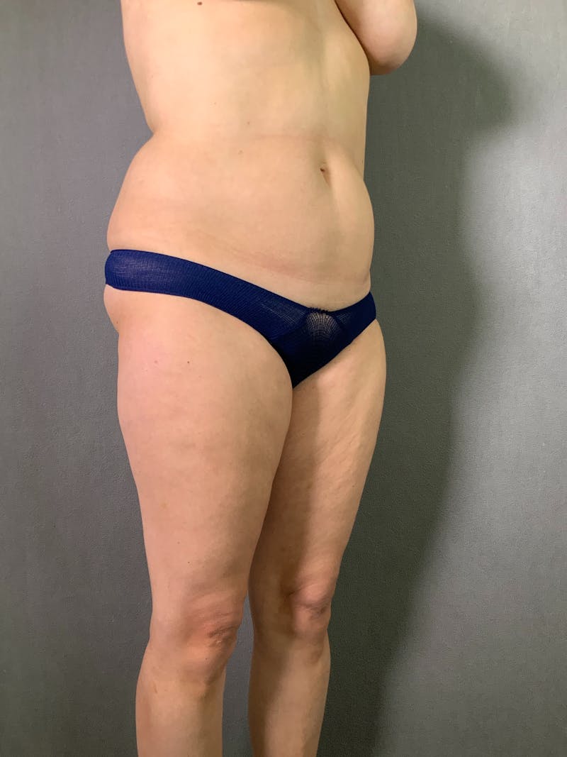Liposuction Before & After Gallery - Patient 167389506 - Image 3