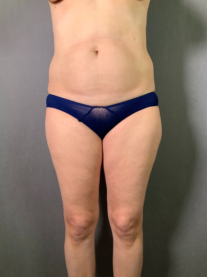 Liposuction Before & After Gallery - Patient 167389506 - Image 1