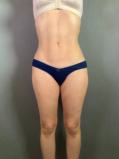 High Def Liposuction Renuvion Before & After Gallery - Patient 164227888 - Image 2
