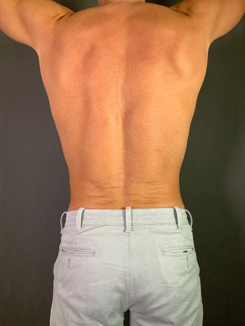 High Def Liposuction Renuvion Before & After Gallery - Patient 164233896 - Image 18