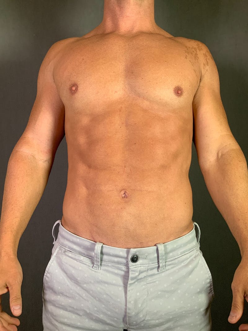High Def Liposuction Renuvion Before & After Gallery - Patient 164233896 - Image 4