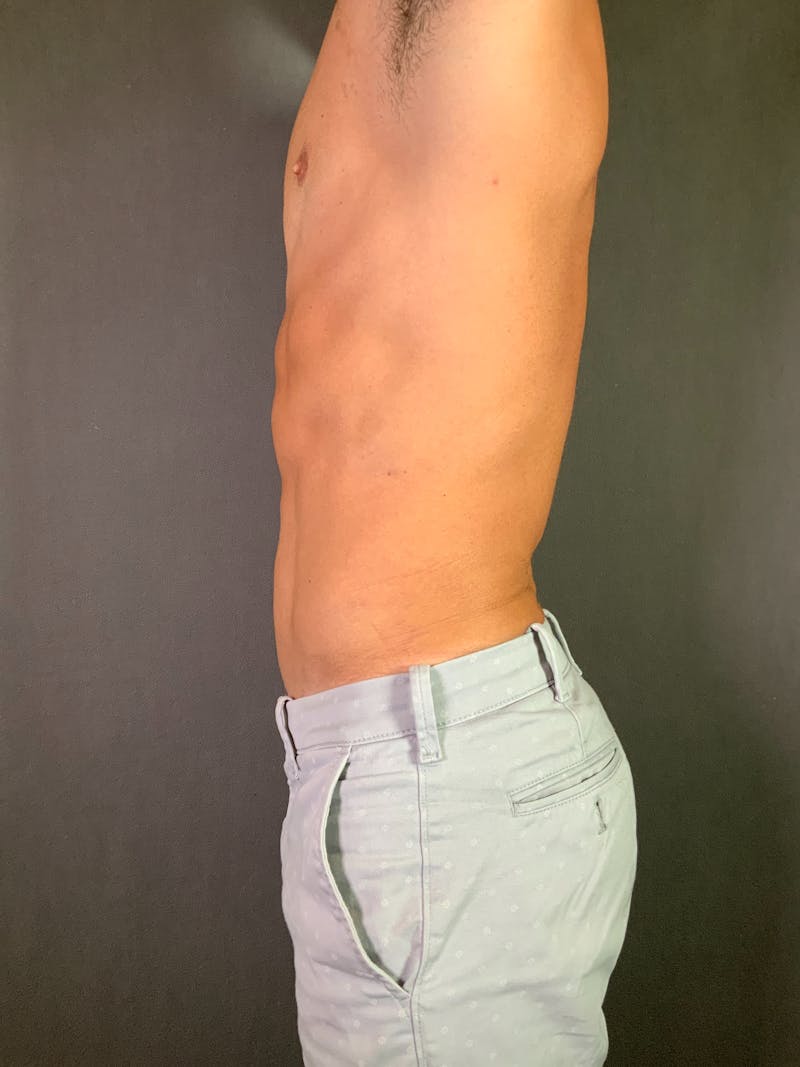 High Def Liposuction Renuvion Before & After Gallery - Patient 164233896 - Image 16