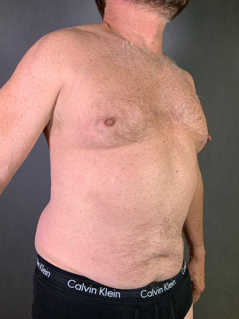 High Def Liposuction Renuvion Before & After Gallery - Patient 164233978 - Image 3
