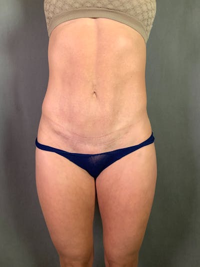 High Def Liposuction Renuvion Before & After Gallery - Patient 164234113 - Image 2